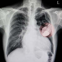 EP Medical Implants Test Kit