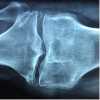 EP Osteoporosis Test Kit